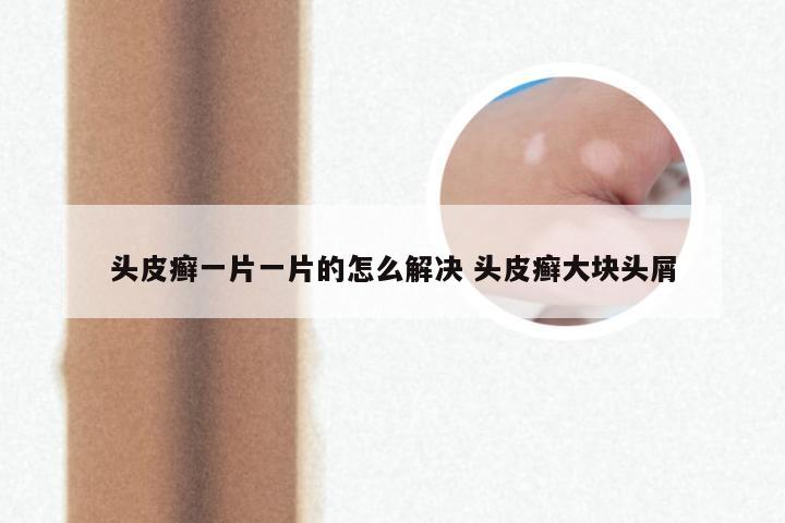 头皮癣一片一片的怎么解决 头皮癣大块头屑
