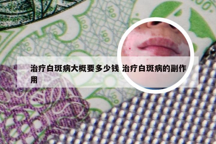 治疗白斑病大概要多少钱 治疗白斑病的副作用
