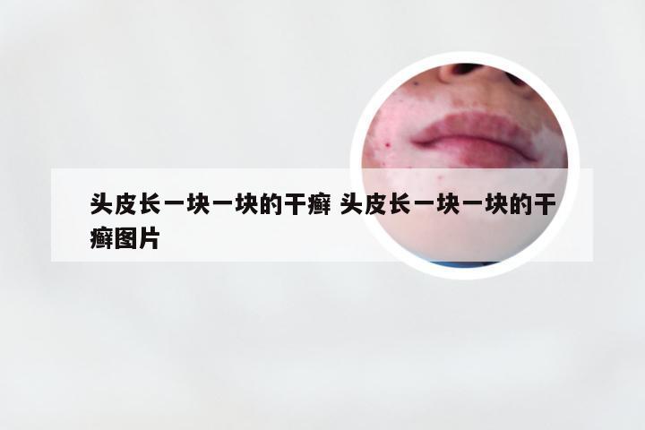 头皮长一块一块的干癣 头皮长一块一块的干癣图片