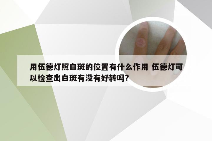 用伍德灯照白斑的位置有什么作用 伍德灯可以检查出白斑有没有好转吗?