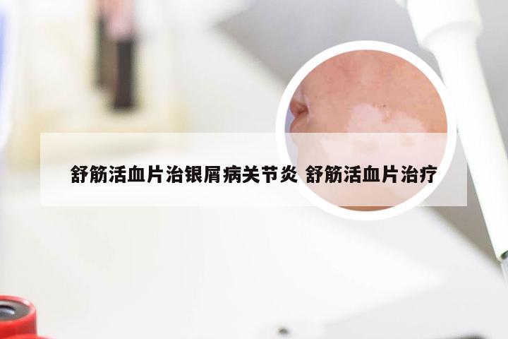 舒筋活血片治银屑病关节炎 舒筋活血片治疗