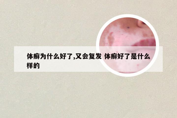 体癣为什么好了,又会复发 体癣好了是什么样的