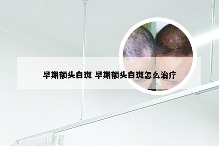 早期额头白斑 早期额头白斑怎么治疗