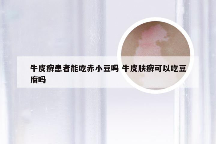 牛皮癣患者能吃赤小豆吗 牛皮肤癣可以吃豆腐吗