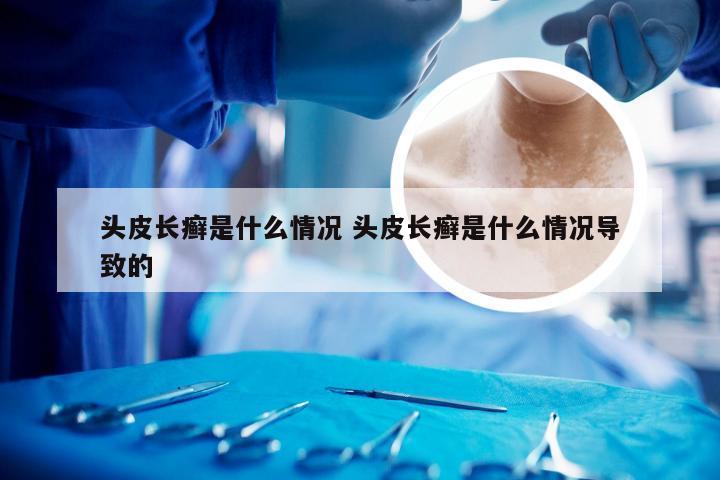 头皮长癣是什么情况 头皮长癣是什么情况导致的