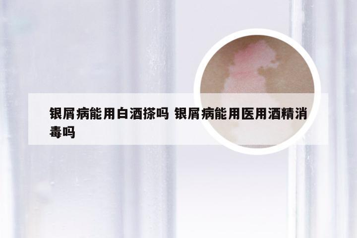 银屑病能用白酒搽吗 银屑病能用医用酒精消毒吗