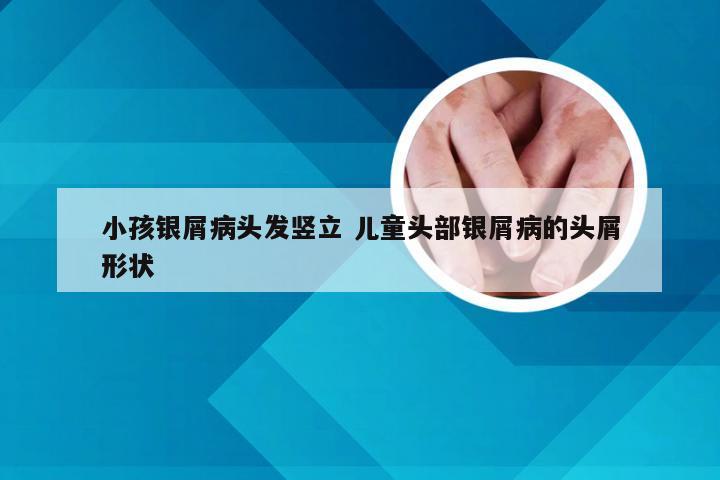 小孩银屑病头发竖立 儿童头部银屑病的头屑形状