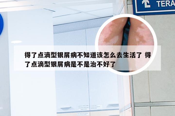 得了点滴型银屑病不知道该怎么去生活了 得了点滴型银屑病是不是治不好了