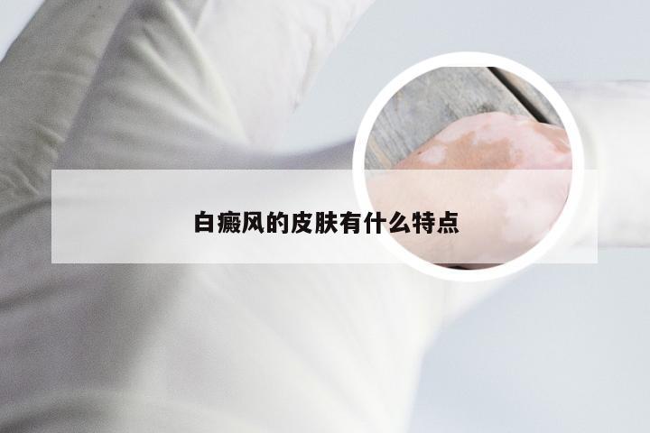 白癜风的皮肤有什么特点