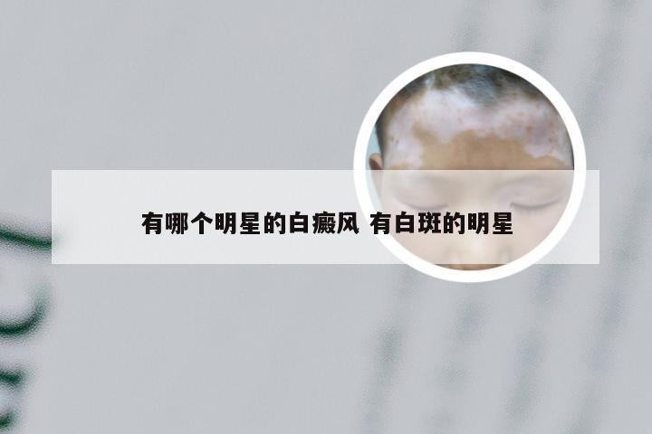 有哪个明星的白癜风 有白斑的明星