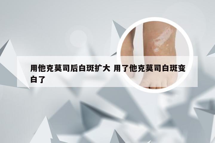 用他克莫司后白斑扩大 用了他克莫司白斑变白了