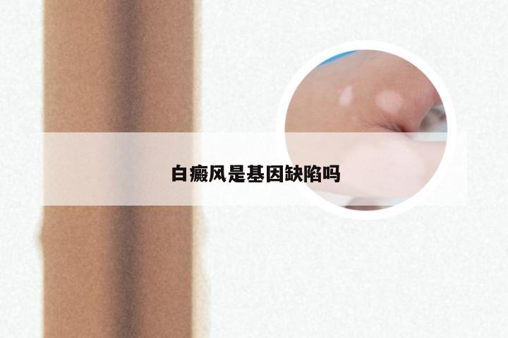 白癜风是基因缺陷吗