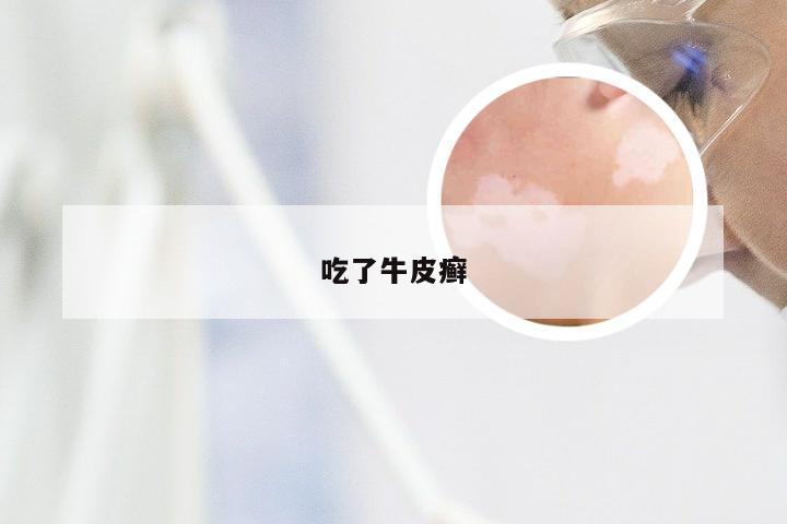 吃了牛皮癣