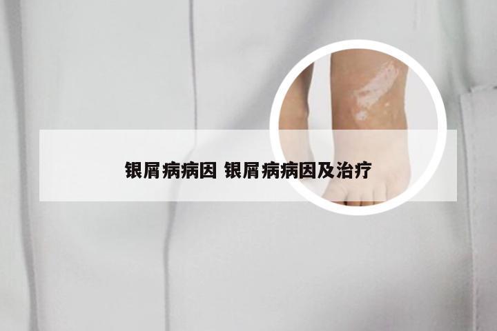 银屑病病因 银屑病病因及治疗