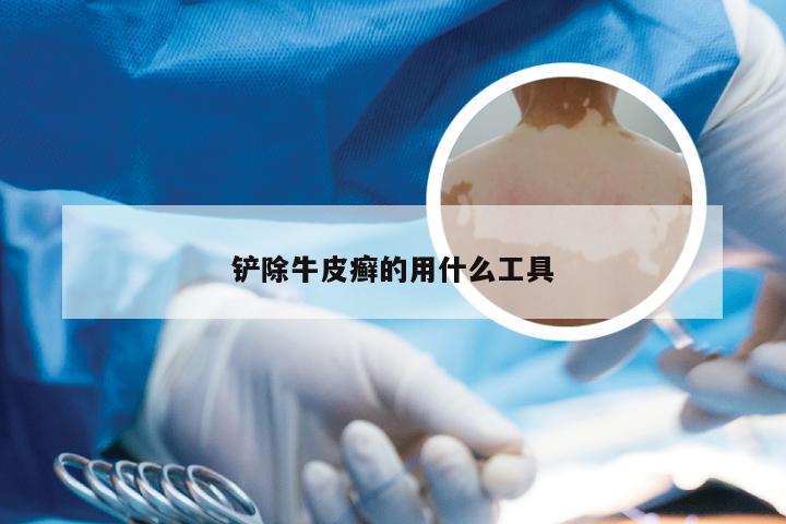 铲除牛皮癣的用什么工具