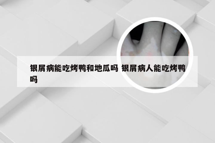 银屑病能吃烤鸭和地瓜吗 银屑病人能吃烤鸭吗