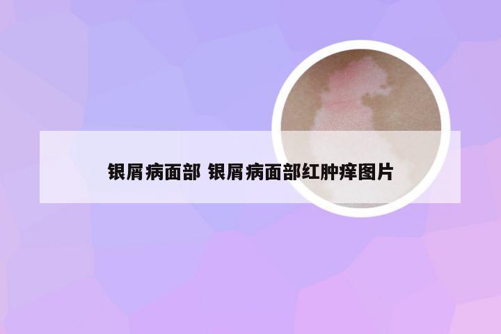 银屑病面部 银屑病面部红肿痒图片