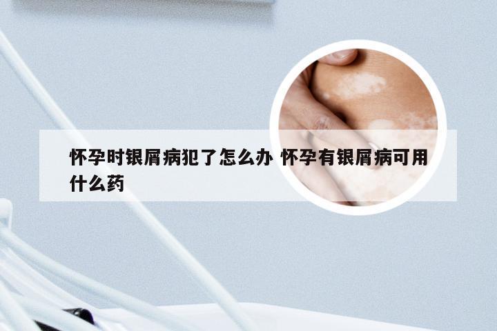 怀孕时银屑病犯了怎么办 怀孕有银屑病可用什么药