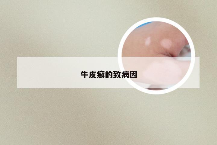牛皮癣的致病因