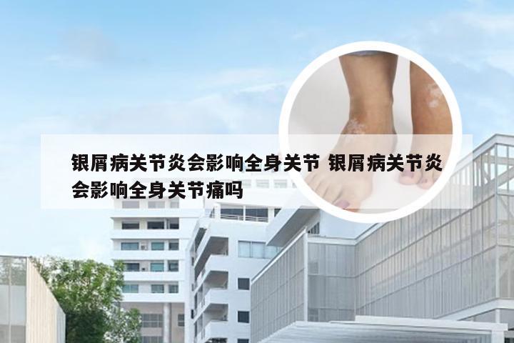银屑病关节炎会影响全身关节 银屑病关节炎会影响全身关节痛吗