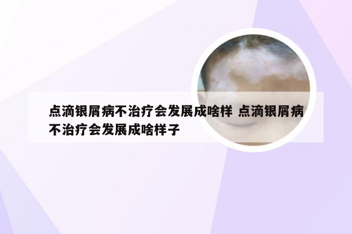 点滴银屑病不治疗会发展成啥样 点滴银屑病不治疗会发展成啥样子