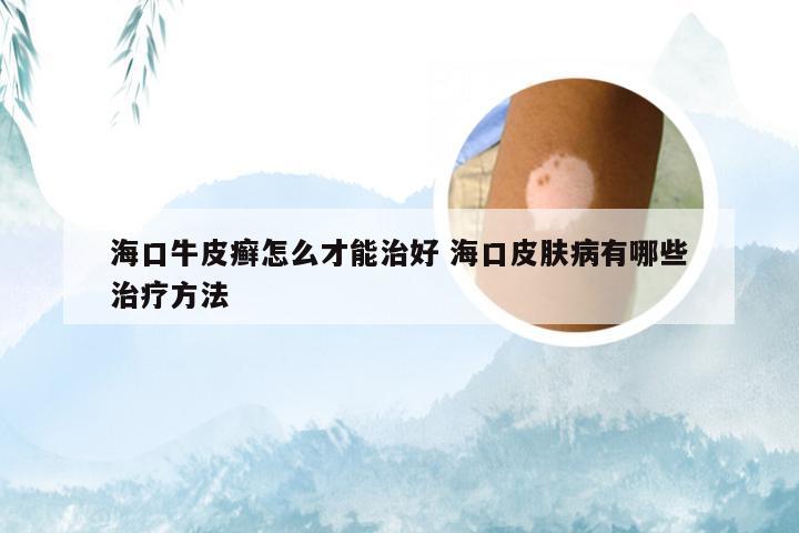 海口牛皮癣怎么才能治好 海口皮肤病有哪些治疗方法