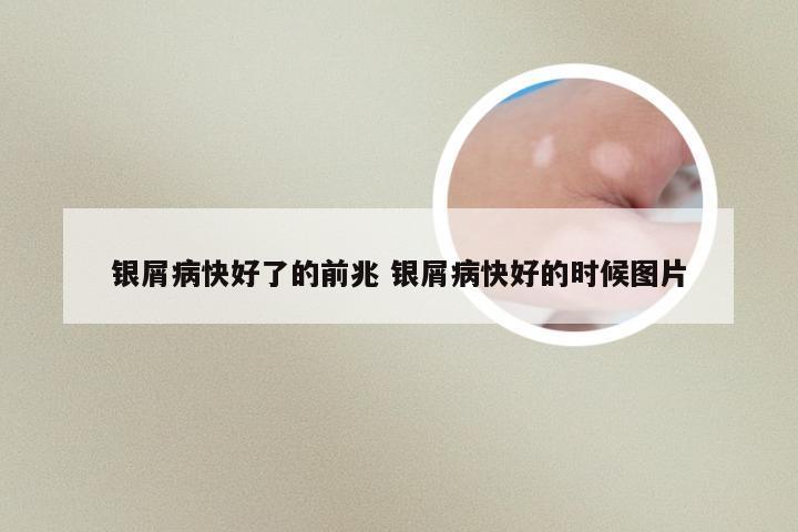 银屑病快好了的前兆 银屑病快好的时候图片