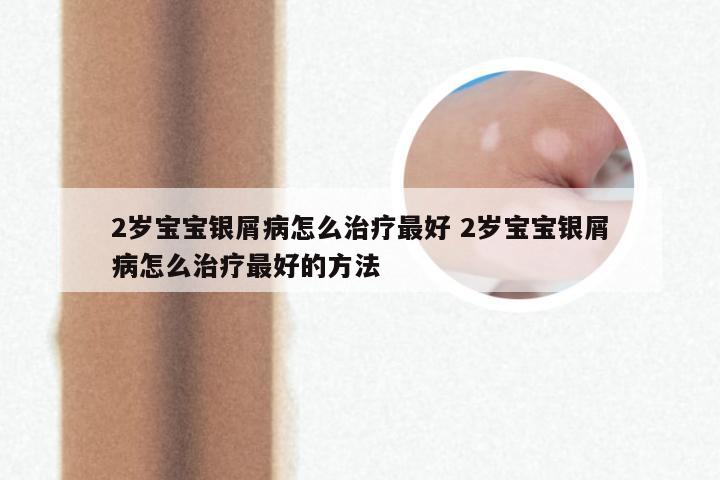 2岁宝宝银屑病怎么治疗最好 2岁宝宝银屑病怎么治疗最好的方法