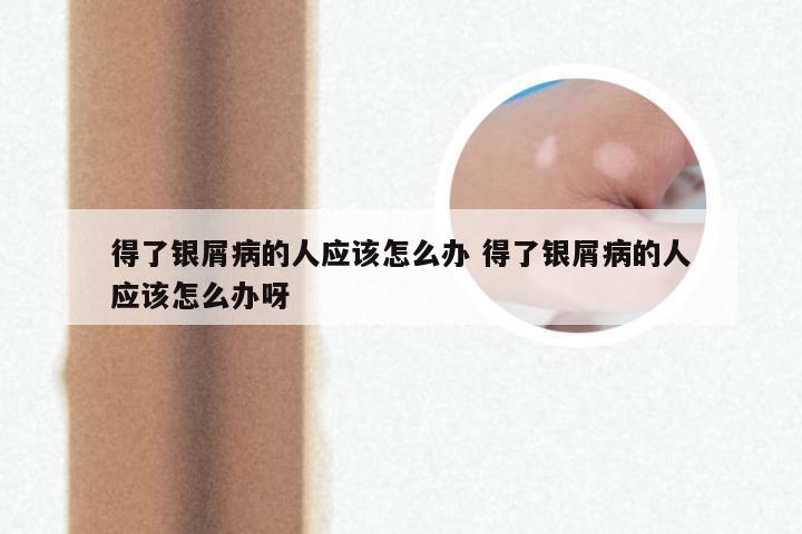 得了银屑病的人应该怎么办 得了银屑病的人应该怎么办呀