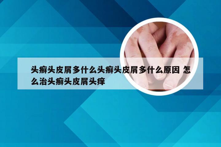 头癣头皮屑多什么头癣头皮屑多什么原因 怎么治头癣头皮屑头痒