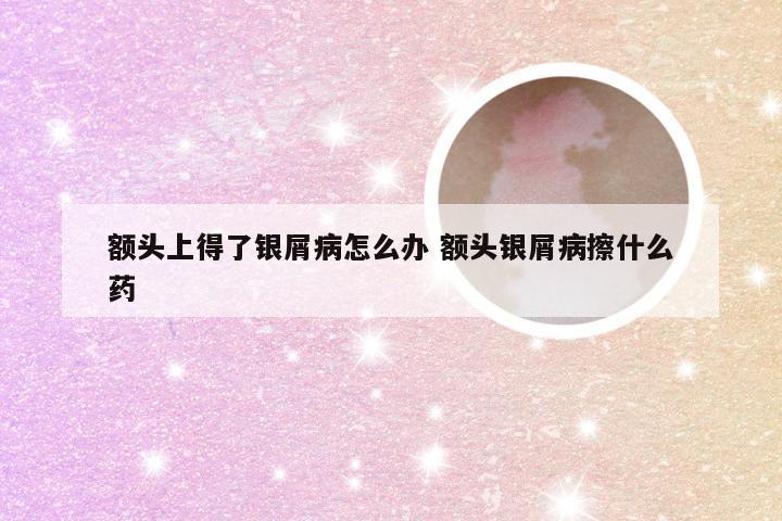 额头上得了银屑病怎么办 额头银屑病擦什么药