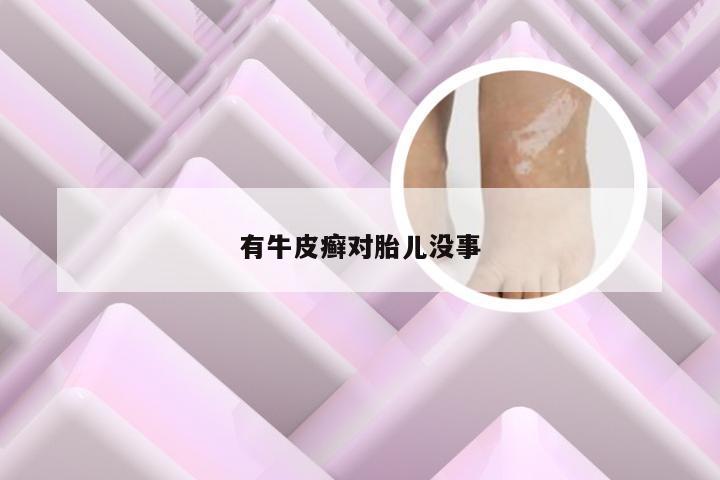 有牛皮癣对胎儿没事