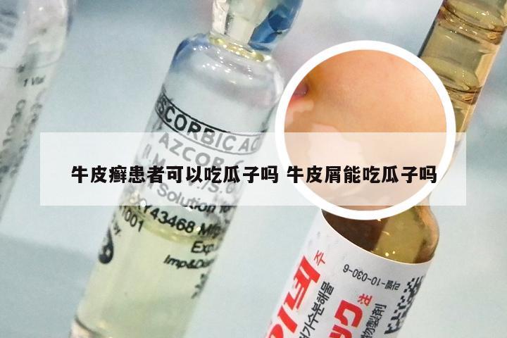牛皮癣患者可以吃瓜子吗 牛皮屑能吃瓜子吗