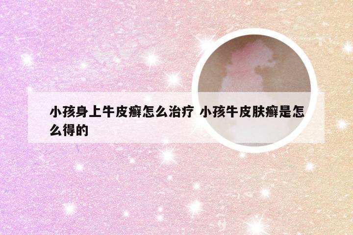 小孩身上牛皮癣怎么治疗 小孩牛皮肤癣是怎么得的