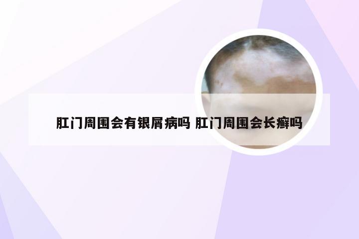肛门周围会有银屑病吗 肛门周围会长癣吗