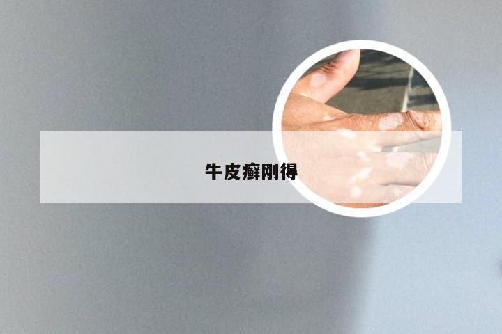 牛皮癣刚得