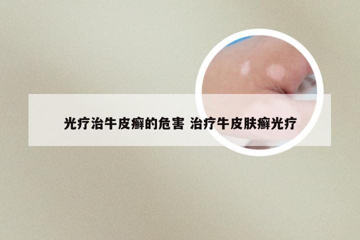 光疗治牛皮癣的危害 治疗牛皮肤癣光疗