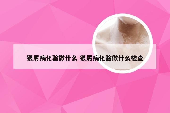 银屑病化验做什么 银屑病化验做什么检查