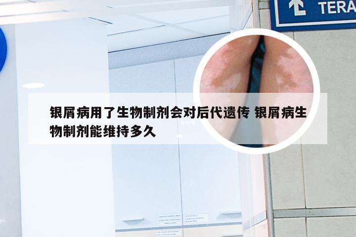 银屑病用了生物制剂会对后代遗传 银屑病生物制剂能维持多久