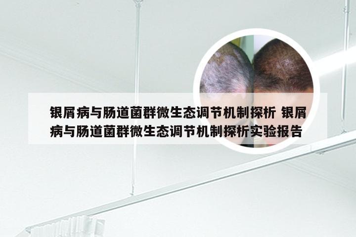 银屑病与肠道菌群微生态调节机制探析 银屑病与肠道菌群微生态调节机制探析实验报告