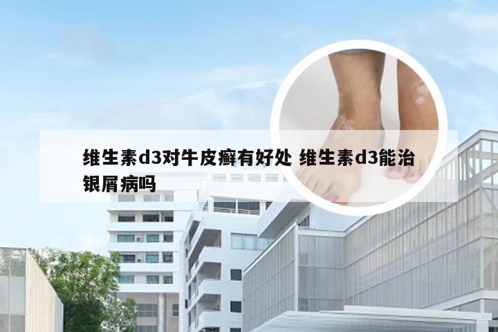 维生素d3对牛皮癣有好处 维生素d3能治银屑病吗