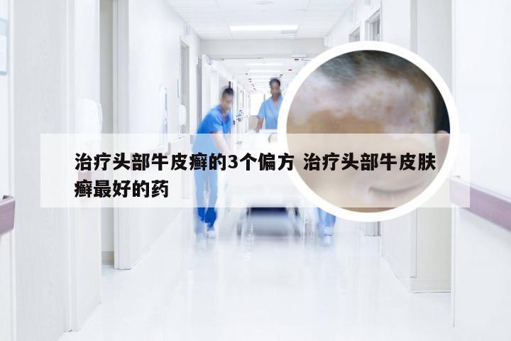 治疗头部牛皮癣的3个偏方 治疗头部牛皮肤癣最好的药