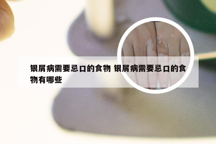 银屑病需要忌口的食物 银屑病需要忌口的食物有哪些