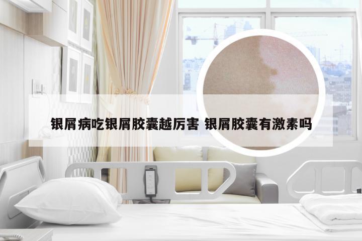 银屑病吃银屑胶囊越厉害 银屑胶囊有激素吗