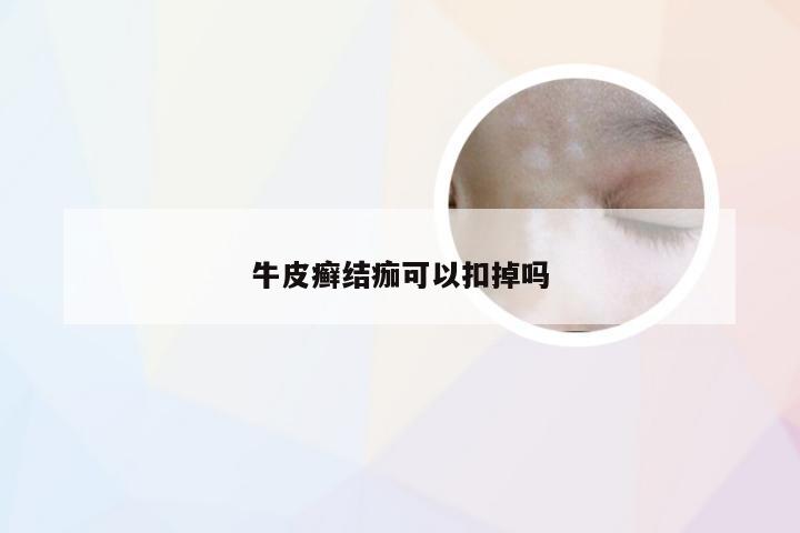牛皮癣结痂可以扣掉吗
