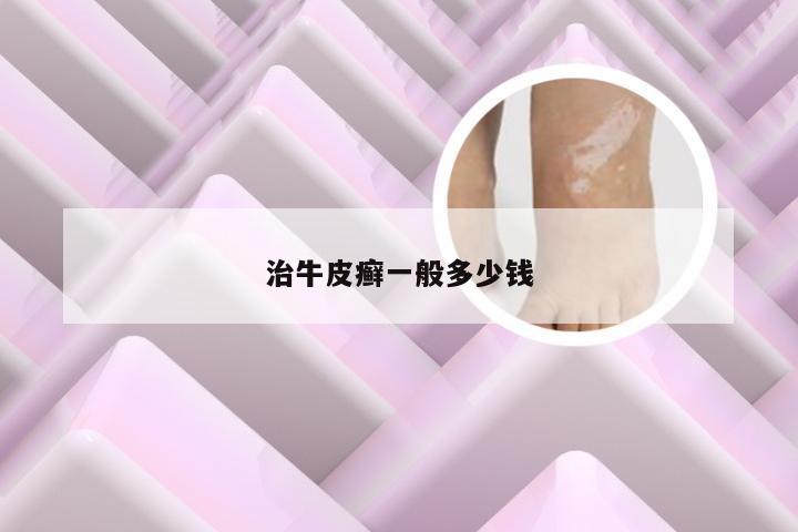 治牛皮癣一般多少钱