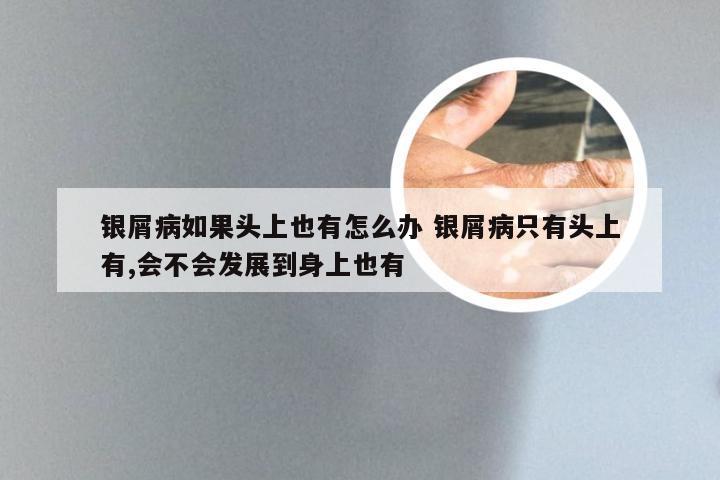 银屑病如果头上也有怎么办 银屑病只有头上有,会不会发展到身上也有
