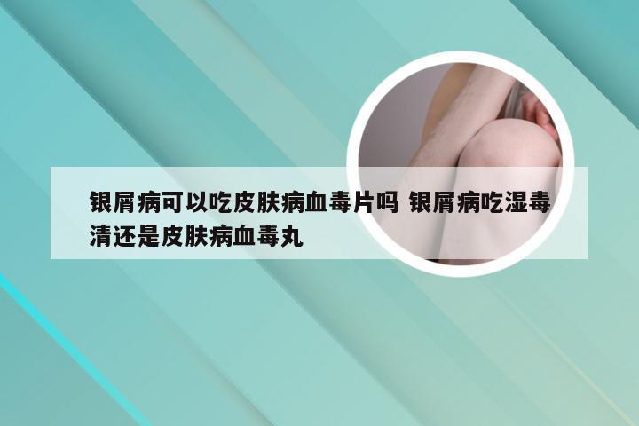 银屑病可以吃皮肤病血毒片吗 银屑病吃湿毒清还是皮肤病血毒丸