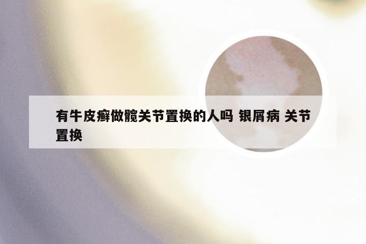 有牛皮癣做髋关节置换的人吗 银屑病 关节置换