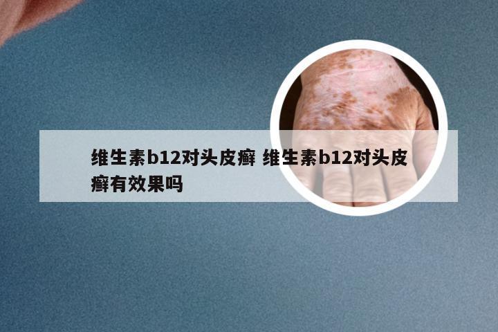 维生素b12对头皮癣 维生素b12对头皮癣有效果吗
